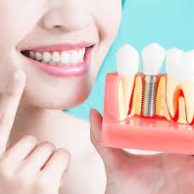 Best Dental Implant Clinic in Toronto