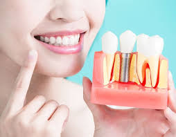 Best Dental Implant Clinic in Toronto